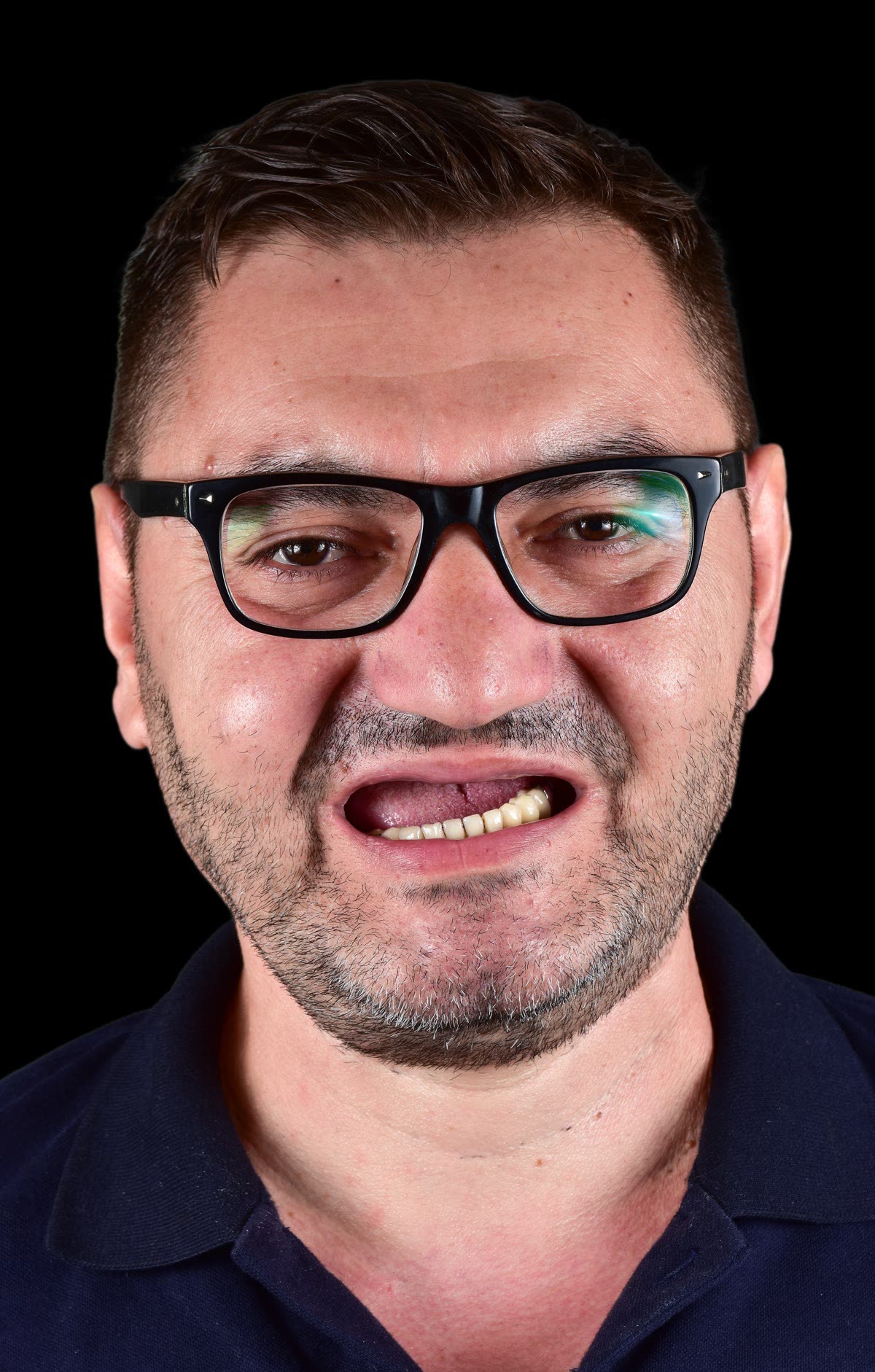 Pacijent pre ugradnje implanata
