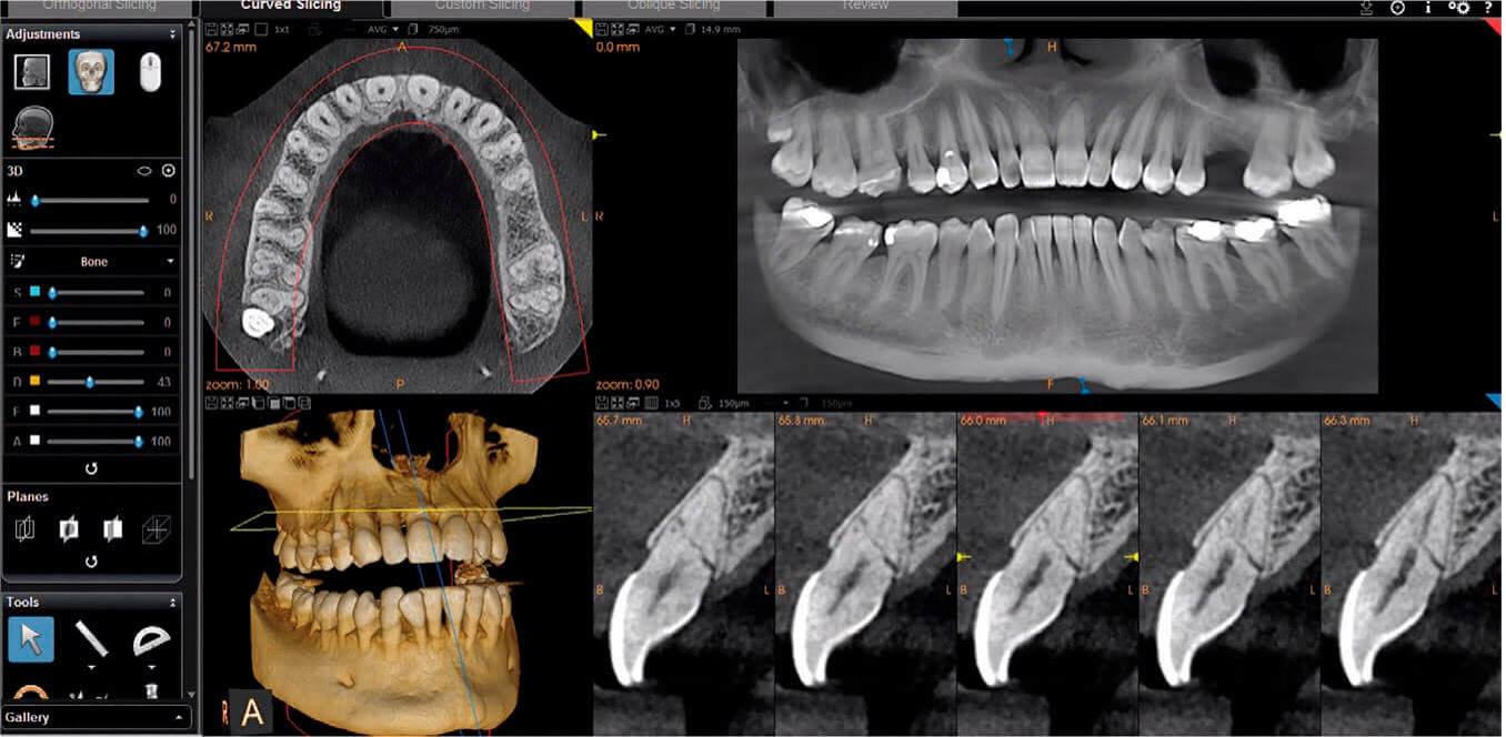 3D CBCT snimak vilice u dijagnostičkom softveru
